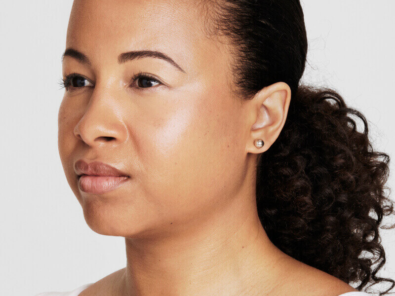 halbprofil einer patientin nach der ultherapy behandlung