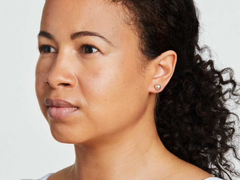 halbprofil einer patientin vor der ultherapy behandlung