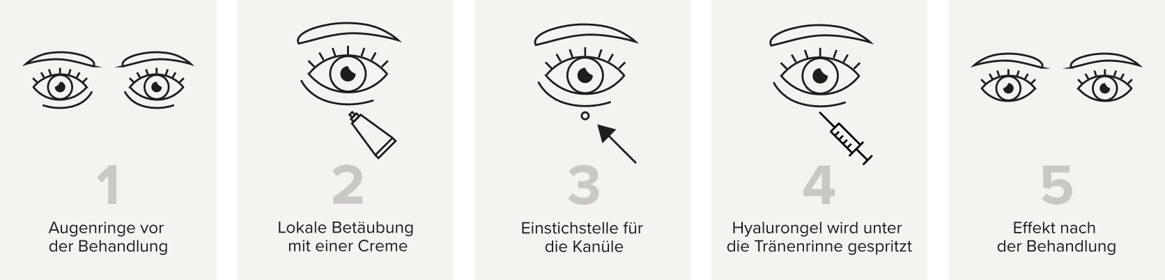 schematische darstellung der behandlung von augenringen durch belotero