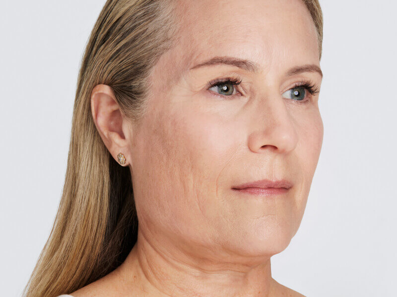 halbprofil einer patientin nach der ultherapy behandlung