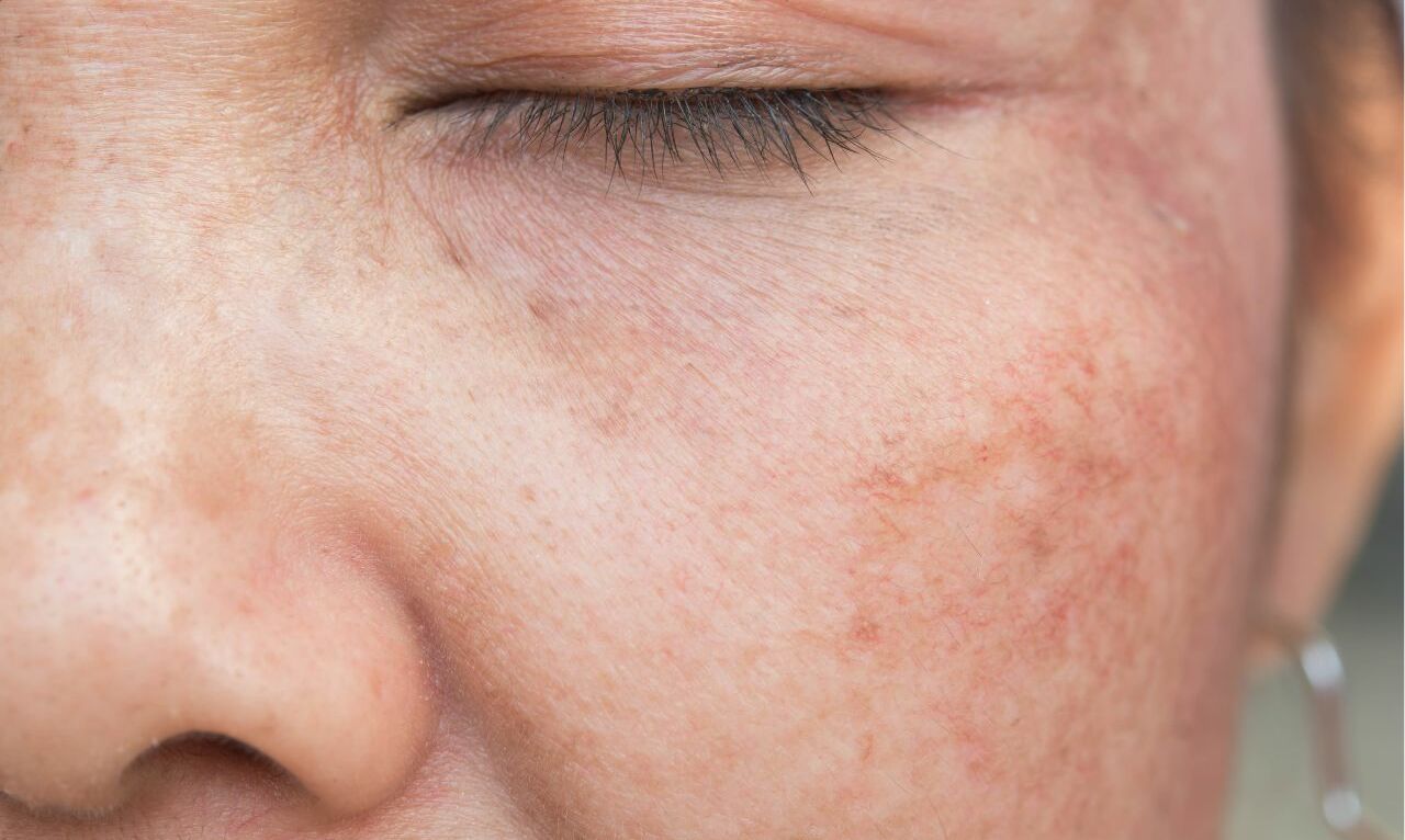sonnengeschädigte Haut im gesicht, nahaufnahme